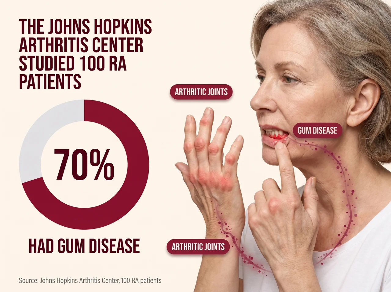 Johns Hopkins Arthritis Center study: 70% of 100 RA patients had gum disease, showing the connection between arthritic joints and gum disease
